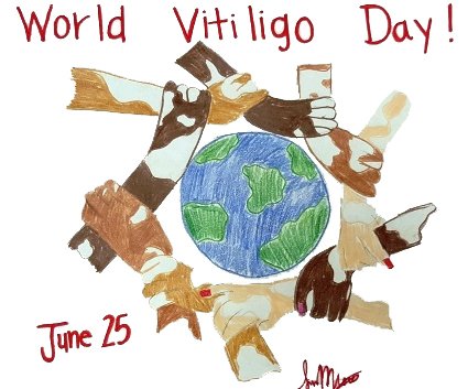 World Vitiligo Day : 25 June